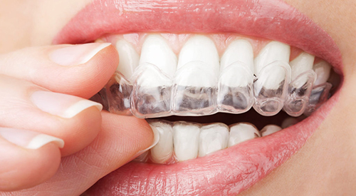 clear aligners/ Invisalign