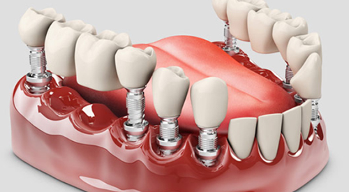 Prosthodontics