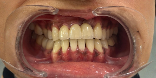 Case 1 After